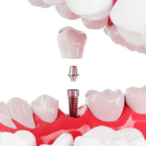 Implantes dentales en Murcia