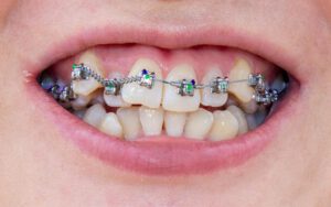 Ortodoncia. Piezas dentales mal alineadas