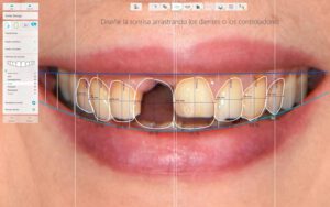 Diseño digital de sonrisa de una paciente en Murcia
