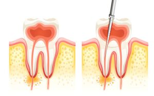 Tipos de endodoncia