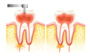 Tipos de endodoncia
