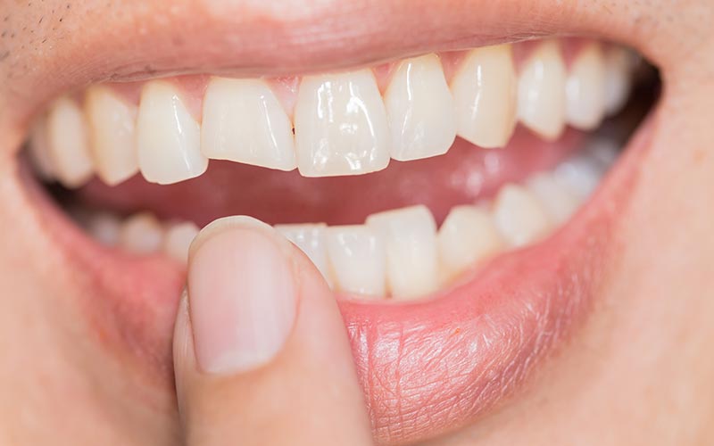 Endodoncia en diente fracturado