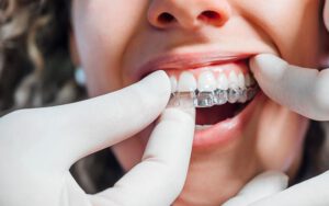 Ortodoncia invisible en paciente